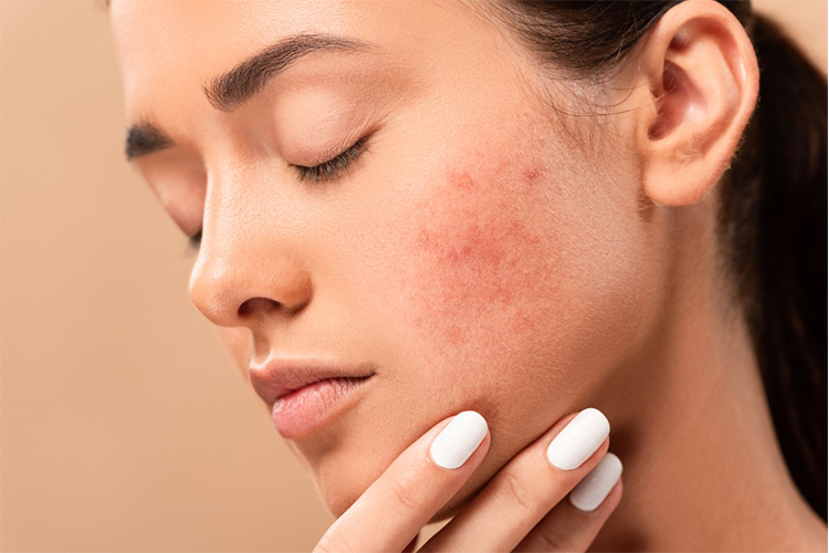 Hormonal acne: causes, treatment and foods to avoid