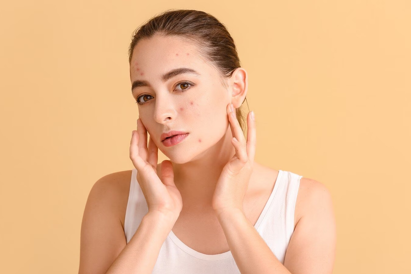 Hormonal Acne Unveiled Understanding Causes, Treatment, and Foods to Steer Clear Of